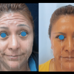 rejuvenecimiento facial sin cirugía en León