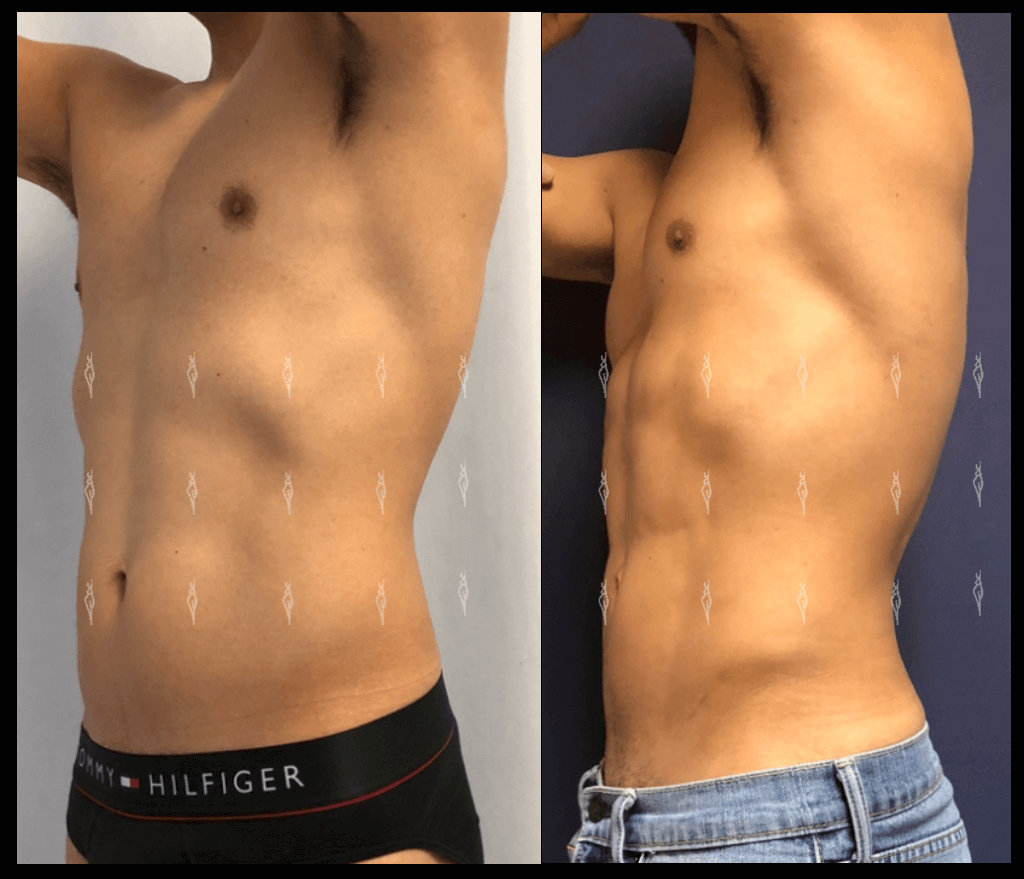 Lipoescultura de alta definición en León