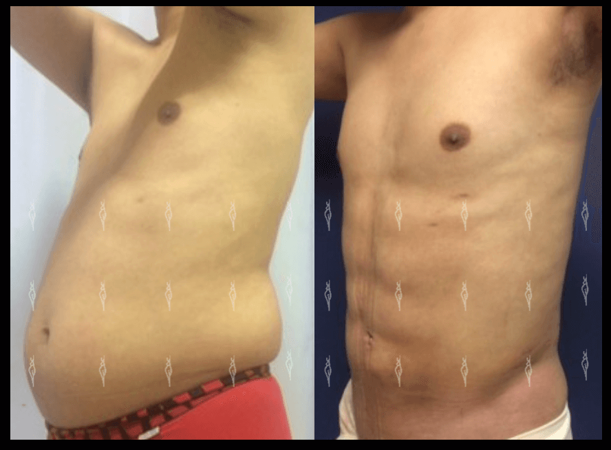 Lipoescultura de alta definición en León