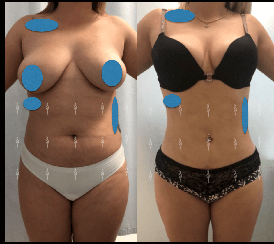 Lipoescultura de alta definición en León