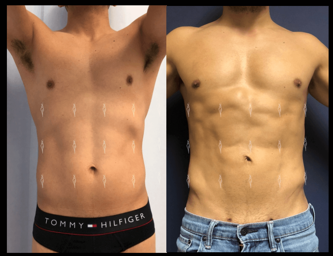 Lipoescultura para marcaje de abdomen en León