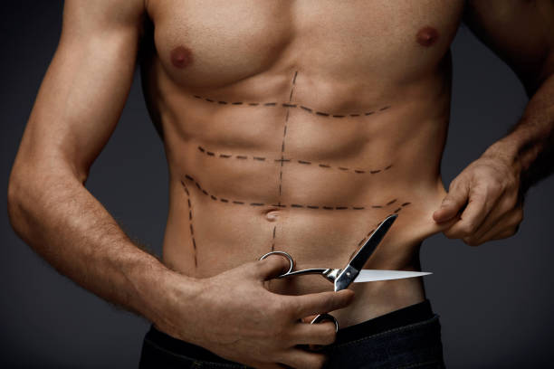 Lipoescultura para marcaje de abdomen en León