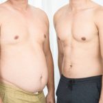 liposucción en León