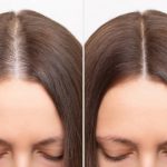 Tratamiento de plasma rico en plaquetas León Guanajuato