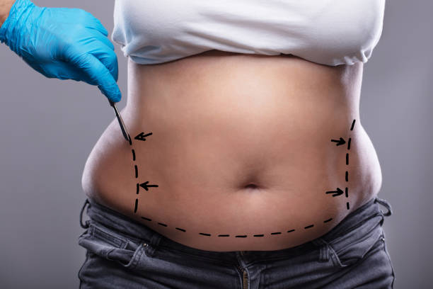 mujer con abdomen abultado