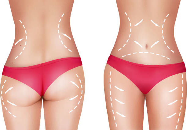 zonas a tratar en la lipoescultura