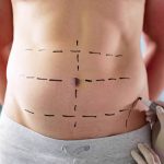 Abdominoplastia en León