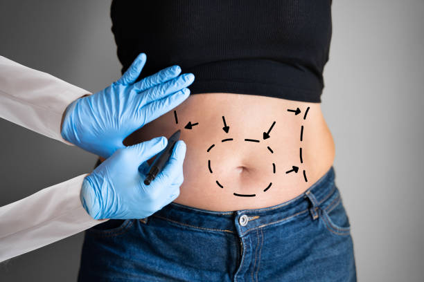 Abdominoplastia en León