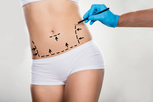 Abdominoplastia en León