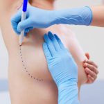 Reconstrucción de mama en León