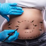 abdominoplastia en León