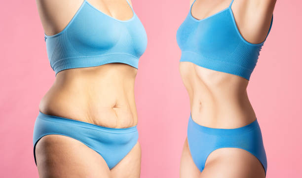 abdominoplastia en León