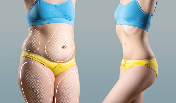 abdominoplastia en León