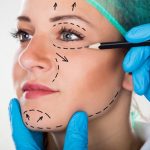 mujer con marcas para cirugía en rostro