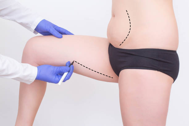 médico poniendo marcas en abdomen y pierna de mujer