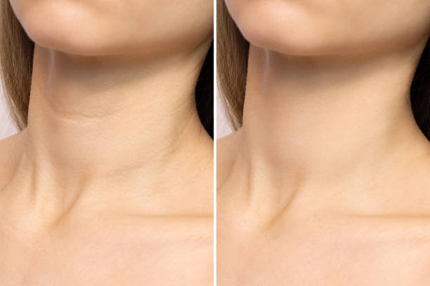 comparativa de cuello de mujer antes y después