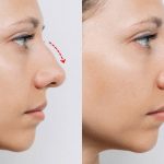 antes y después rinoplastia