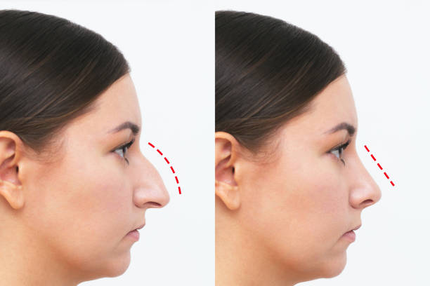 antes y después rinoplastia