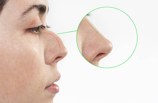 antes y después rinoplastia